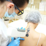 Tattooentfernung Kosten