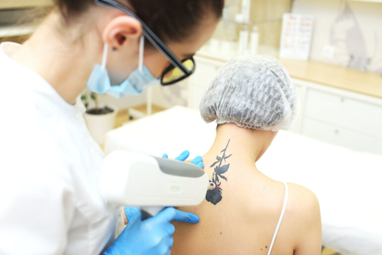 Teure Reue: So viel kostet eine Tattooentfernung